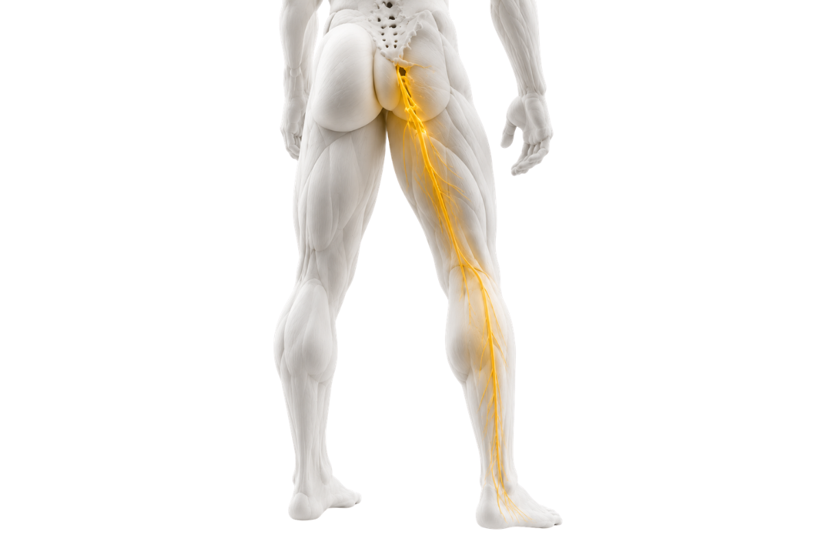 Sciatica