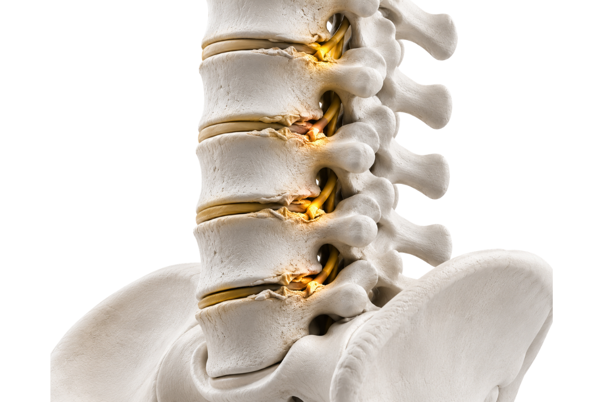 Lumbar Spondylosis