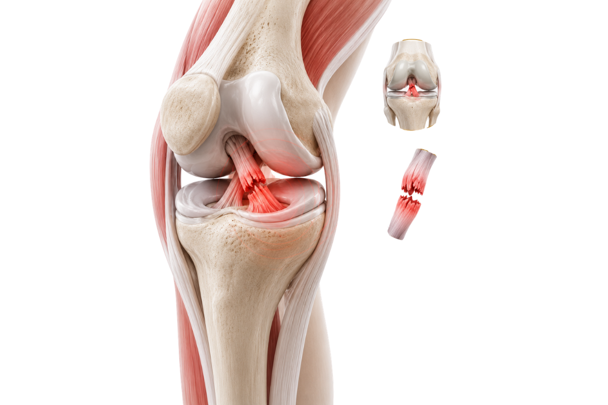 ACL Injury
